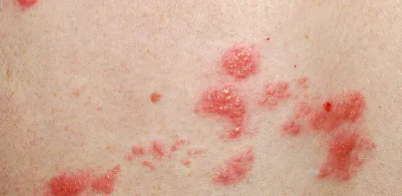 Gürtelrose (Zoster) kann sehr schmerzhaft sein