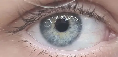Erkrankungen der Augenwimpern