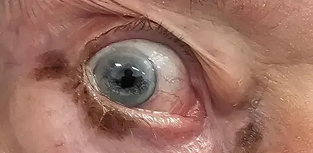 Melanosis in situ