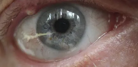 Das Gerstenkorn und Hagelkorn am Auge
